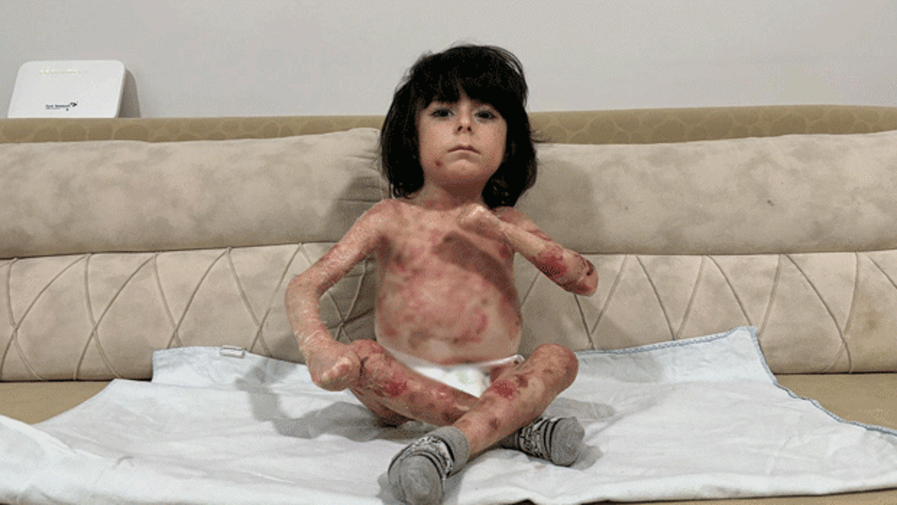 4 yaşındaki İbrahim'in ailesinden yürek yakan feryat! Hastalığı yüzünden kıyafet giyemiyor